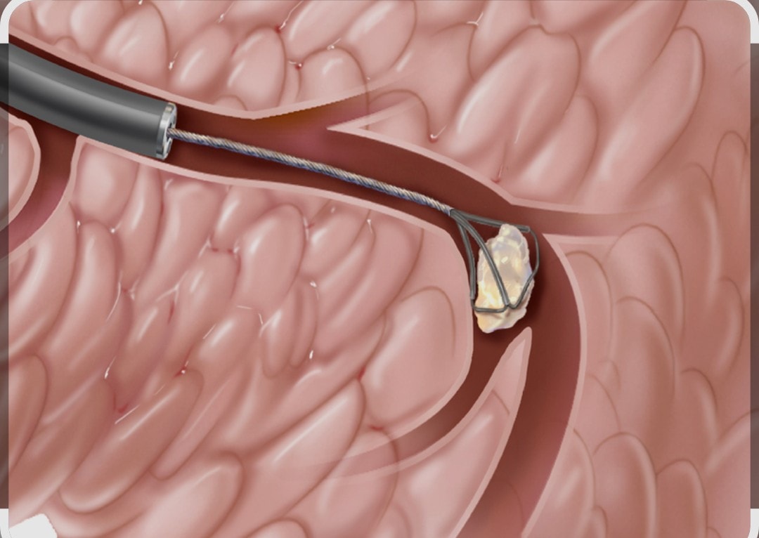 Sialoendoscopy procedure close-up